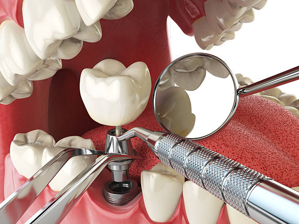 Best Root Canal Emergency Dentist  in Indianola, WA